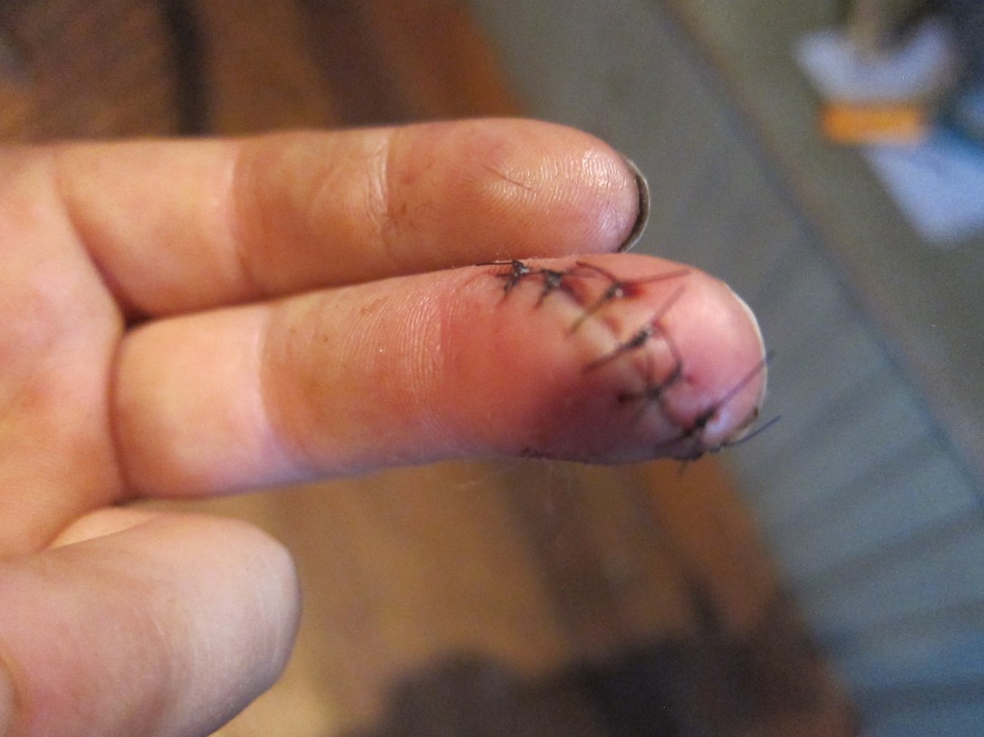 Sometimes a butterfly bandage just doesn't cut it. Heh. "Cut" it... get it? 